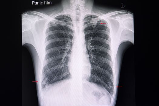 A chest xray film of a patient with multiple nodular infiltrations in the left upper and both right and left lower lungs.