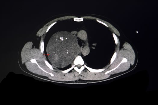 CT scan of a chest of a patient showing a large anterior mediastinal tumor in the right superior mediastinum.