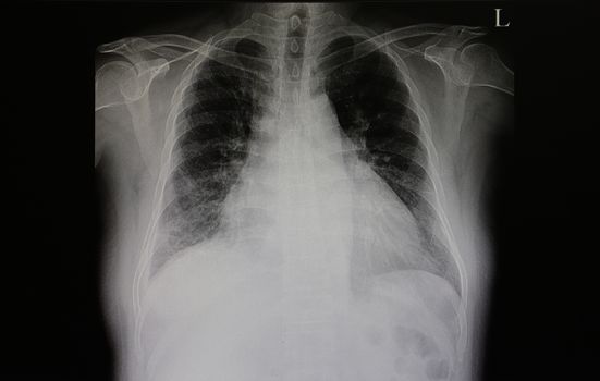 a chest film of a patient with congestive heart failure, an enlarged heart (cardiomegaly) and pulmonary congestion is shown