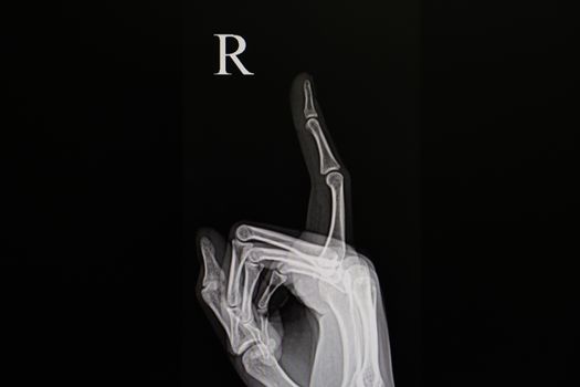 a film xray of a patient with finger tip injury (index finger), a patient's hand and fingers are set in a position that allows clear visualization of the injured finger tip.