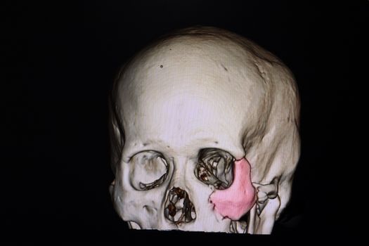 3 D rendering of a skull of a patient with traumatic brain injury showing fracture of left zygomatic bone.