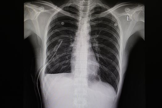 A chest xray film of a patient with right side spontaneous pnemothorax, a chest drain is placed, a small amount of pleural effusion is seen