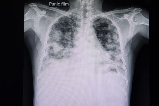 A chest x-ray film of a patient with metastatic carcinoma to both lungs. A large hepatocellular carcinoma was found.