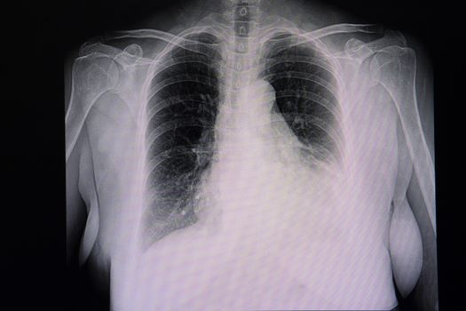 A chest x-ray film of a patient with cardiomegaly and left pleural effusion. Cephalization of pulmonary blood flow.