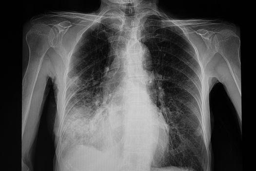 A chest xray film of a patient with pneumonia in the right lower lung. Pulmonary infection. Respiratory failure. Diagnostic film.