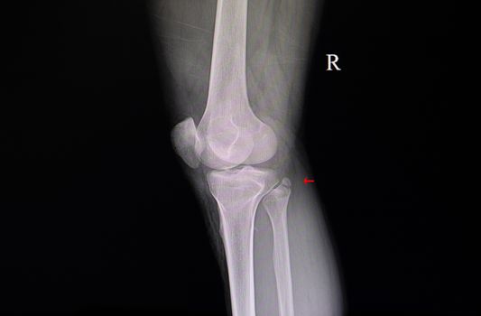 Xray film of a patient knee with fractured right proximal fibular.