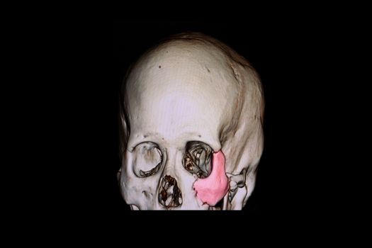 3 D rendering of a skull of a patient with traumatic brain injury showing fracture of left zygomatic bone.