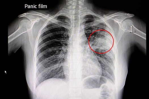 Xray film of a patient with pneumonia in his left middle lung