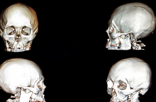 computer tomographic 3 D rendering of patient's skull