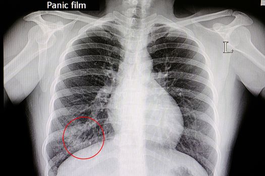 Xray film of a patient with pneumonia in his right lower lung