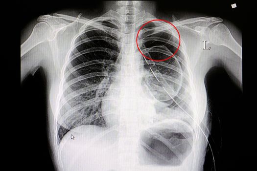 Xray film of a patient with large pneumothorax with a chest drain