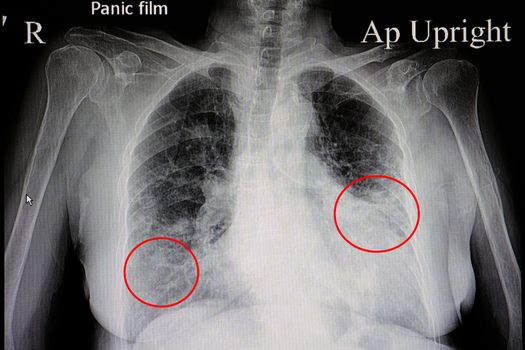 a chest x-ray film of a female patient showing cardiomegaly and bilateral pulmonary congestion