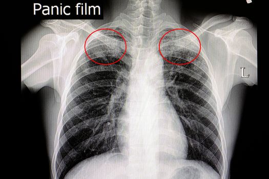 Xray film of a pateint with pulmonary tuberculosis