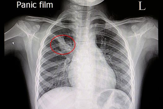 Xray film of a patient with pneumonia and atelectasis in his right upper lung