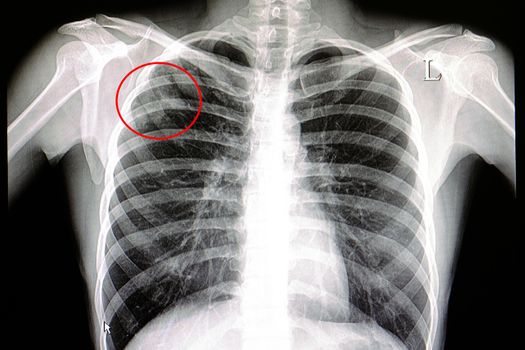 a chest x-ray film of a male patient showing rt upper lobe pulmonary tuberculosis