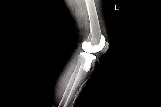 x ray film of a patient with total knee replacement