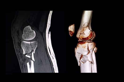 Comparing CT scan and 3D computer rendering image of a knee of the patient suffering from comminuted fracture of tibial plateau and proximal tibia.