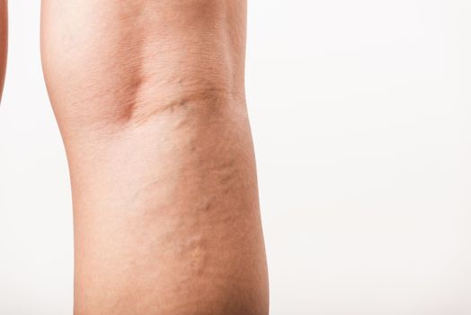 Closeup young Asian woman painful varicose and spider veins on leg, studio shot isolated on white background, Healthcare medical and hygiene skin body varicose veins problems care concept