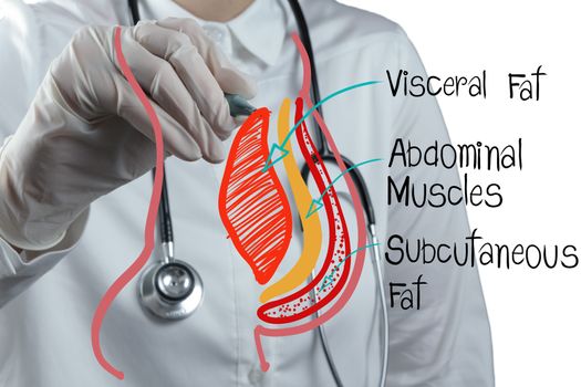 doctor draws abdominal fat as medical concept