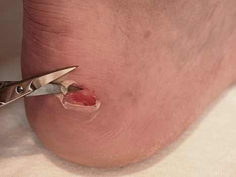Small bended scissors cut skin at  cracked blister on man heel. Painful place with torn skin,  bloody and wetted wound with skin tresses. 