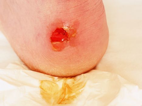 Drying and cleaning cracked bloody blister on heel. A very painful place with torn skin,  bloody and wetted wound with skin tresses. 