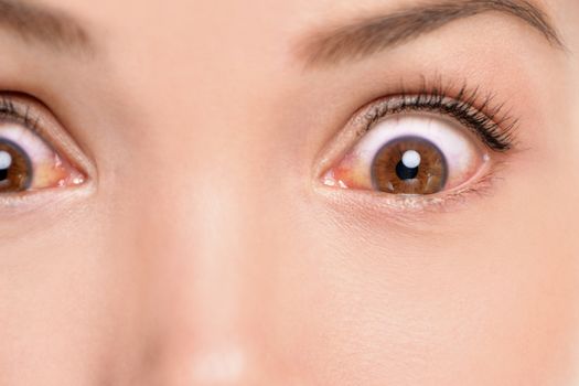 Red eyes woman with allergic reaction conjunctivitis irritated bloodshot eye inflammation. Closeup of shocked upset person with medical problem infection.