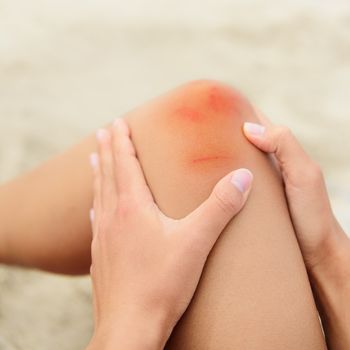 Woman nursing an injured bruised grazed knee with surface petechia on the skin and tissue discoloration in her hands in a healthcare and medical concept, close up of the joint and hands