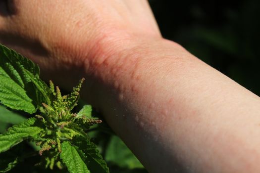 The picture shows stinging nettles and an arm with nettle stings