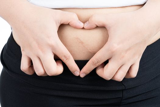Closeup of woman showing scar on her belly from appendicitis surgery with hand heart shape isolated on over white background. Health care and medical concept.