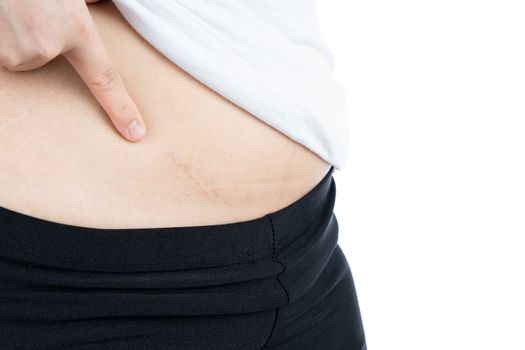 Closeup of woman showing scar on her belly from appendicitis surgery isolated on over white background. Health care and medical concept.
