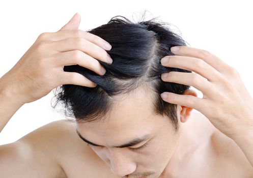 Young man serious hair loss problem for health care medical and shampoo product concept