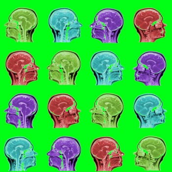 seamless pattern of MRI scans of sixty years old caucasian female head in sagittal or longitudinal plane - colored heads on acid green background.