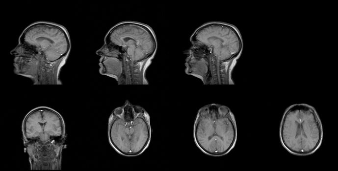 set of serial MRI scans of sixty years old caucasian female head in sagittal and transverse planes.