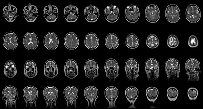 set of serial MRI scans of sixty years old caucasian female head in coronal and transverse planes.