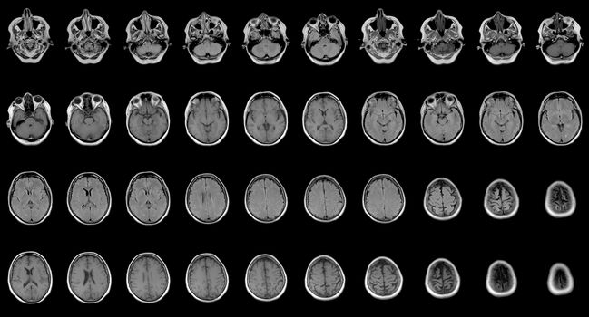 set of sequential MRI scans of sixty years old caucasian female head in two projections