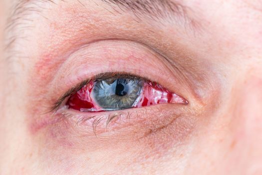 postoperative heavy inflamed eye close-up shot with selective focus and blur