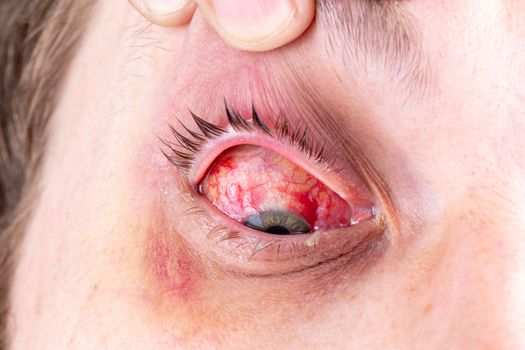 postoperative heavy inflamed eye close-up shot with selective focus and blur - stretched by finger