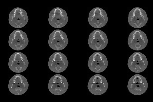 Set of MRI scanner slices of dental part of human male scull with multiple problems on white background. Top-down projection.