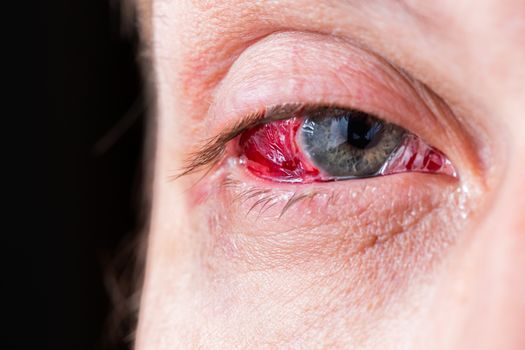 postoperative heavy inflamed eye closeup shot with selective focus and blur