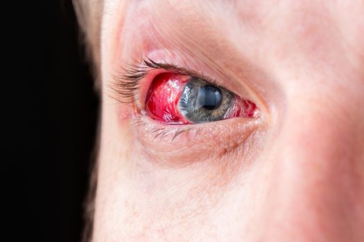 postoperative heavy inflamed eye closeup shot with selective focus and blur