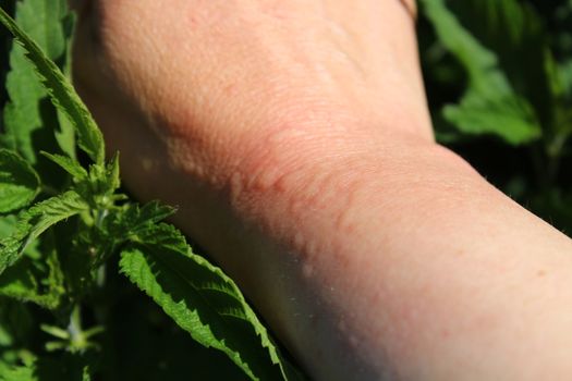 The picture shows stinging nettles and an arm with nettle stings