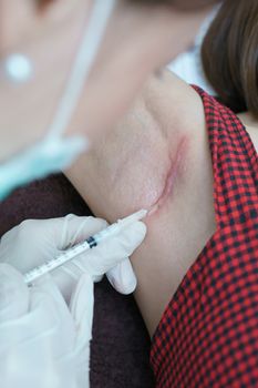Closeup doctor injection treatment for keloids on the armpit.
