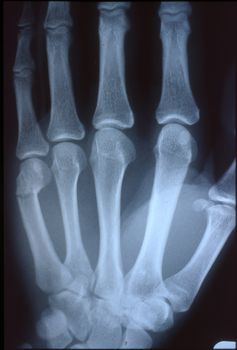 X-ray image, man, hand with bones and joints