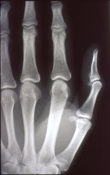 X-ray image, man, hand with bones and joints