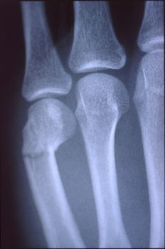 X-ray image, man, hand with bones and joints