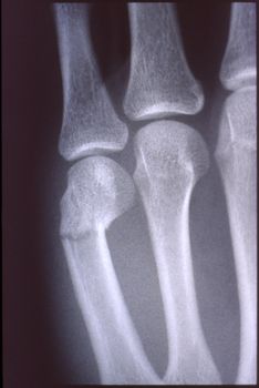 X-ray image, man, hand with bones and joints