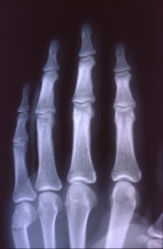 X-ray image, man, hand with bones and joints