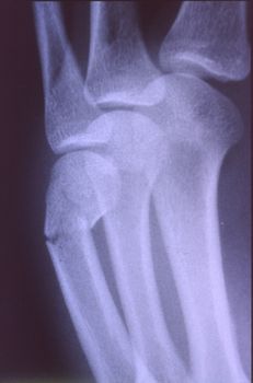 X-ray image, man, hand with bones and joints