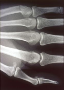 X-ray image, man, hand with bones and joints