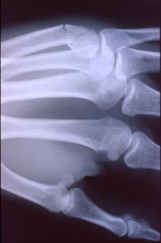 X-ray image, man, hand with bones and joints